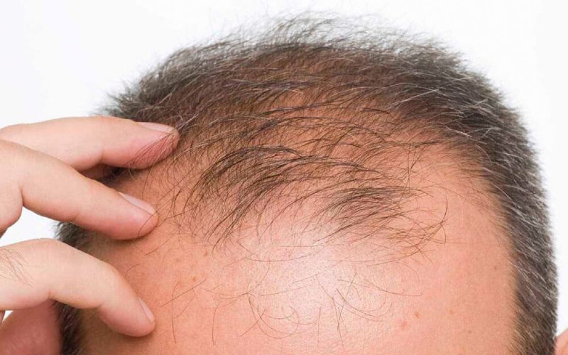 5 alternativas para lidar com a calvície  e a perda de cabelo