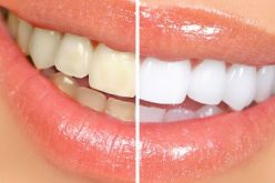 Clareamento dental – tire suas dúvidas