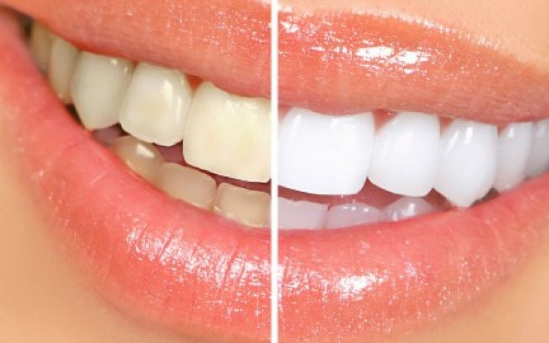 Clareamento dental – tire suas dúvidas