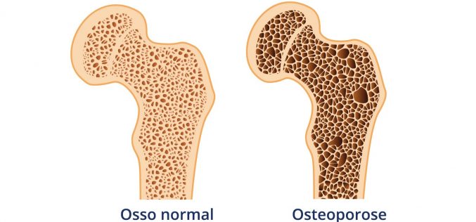O papel da fisioterapia na prevenção e tratamento da osteoporose