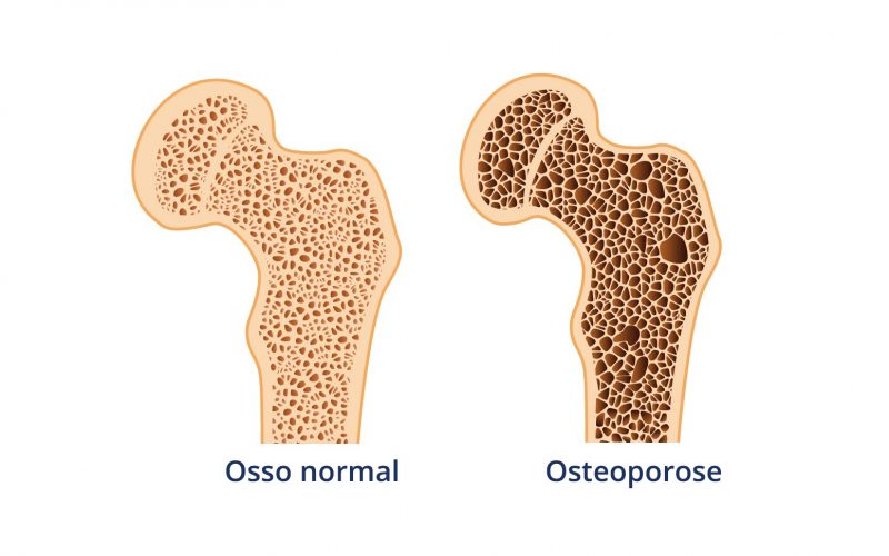 O papel da fisioterapia na prevenção e tratamento da osteoporose