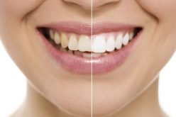 Clareamento pode deixar os dente de 2 a 3 tons mais claros