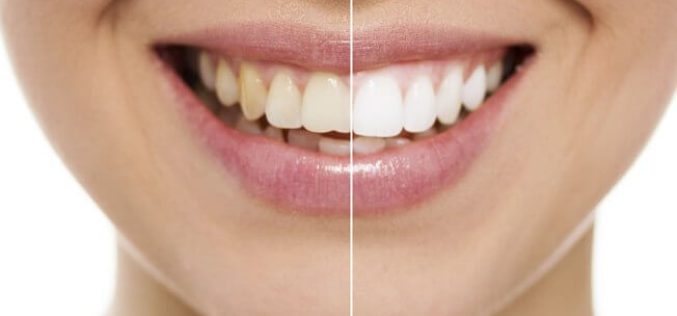 Clareamento pode deixar os dente de 2 a 3 tons mais claros