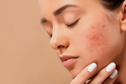 Acne na vida adulta: dicas essenciais para prevenir e melhorar o aspecto de cicatrizes