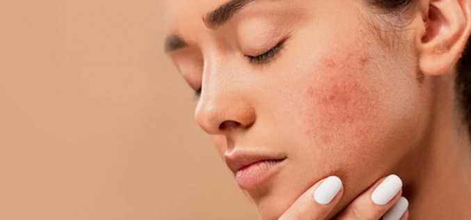 Acne na vida adulta: dicas essenciais para prevenir e melhorar o aspecto de cicatrizes