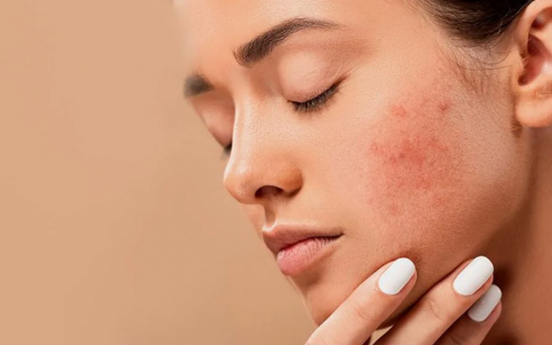 Acne na vida adulta: dicas essenciais para prevenir e melhorar o aspecto de cicatrizes