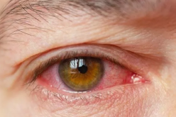 Veja como hábitos do dia a dia podem acarretar sintomas de olho seco