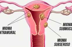 Miomas Uterinos: a importância de conhecer e tratar essa condição feminina