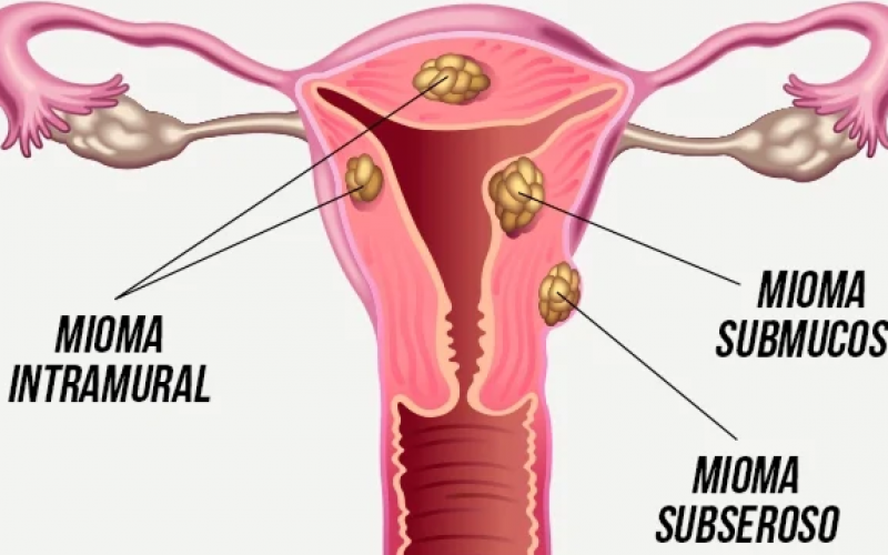 Miomas Uterinos: a importância de conhecer e tratar essa condição feminina