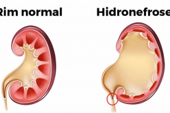 Hidronefrose: o que é, sintomas, causas e tratamento