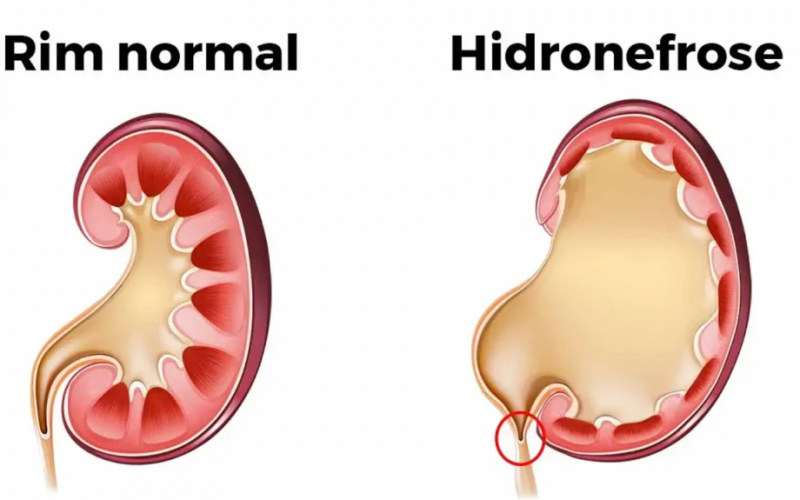 Hidronefrose: o que é, sintomas, causas e tratamento