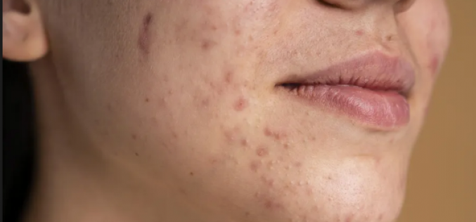 Da dor de cabeça à acne: como alergias alimentares podem estar prejudicando sua saúde e como resolver