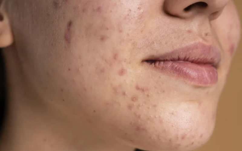 Da dor de cabeça à acne: como alergias alimentares podem estar prejudicando sua saúde e como resolver