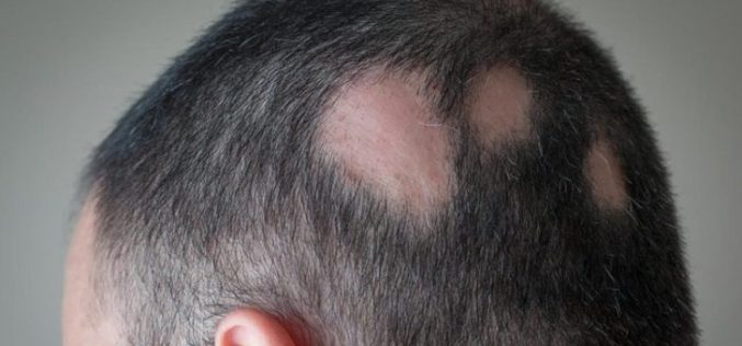 Estudo com mais de 700 pessoas com alopecia areata severa aponta impacto relevante na qualidade de vida