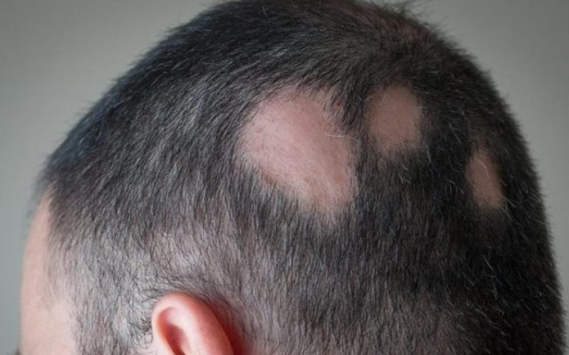 Estudo com mais de 700 pessoas com alopecia areata severa aponta impacto relevante na qualidade de vida