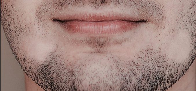 Calvície na barba afeta a autoestima de muitos homens, mas tem solução