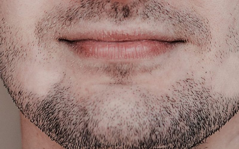 Calvície na barba afeta a autoestima de muitos homens, mas tem solução