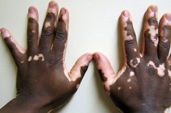 Vitiligo: doença que afeta mais de 1 milhão de brasileiros tem cura?