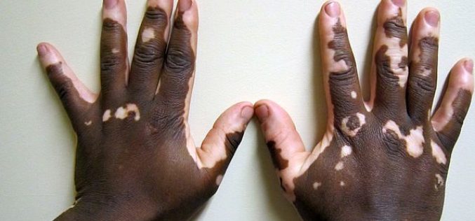 Vitiligo: doença que afeta mais de 1 milhão de brasileiros tem cura?