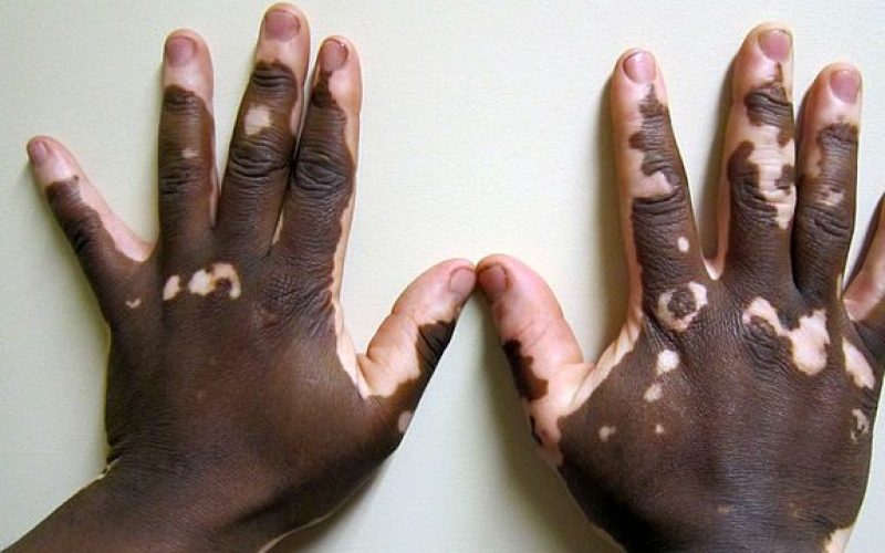 Vitiligo: doença que afeta mais de 1 milhão de brasileiros tem cura?